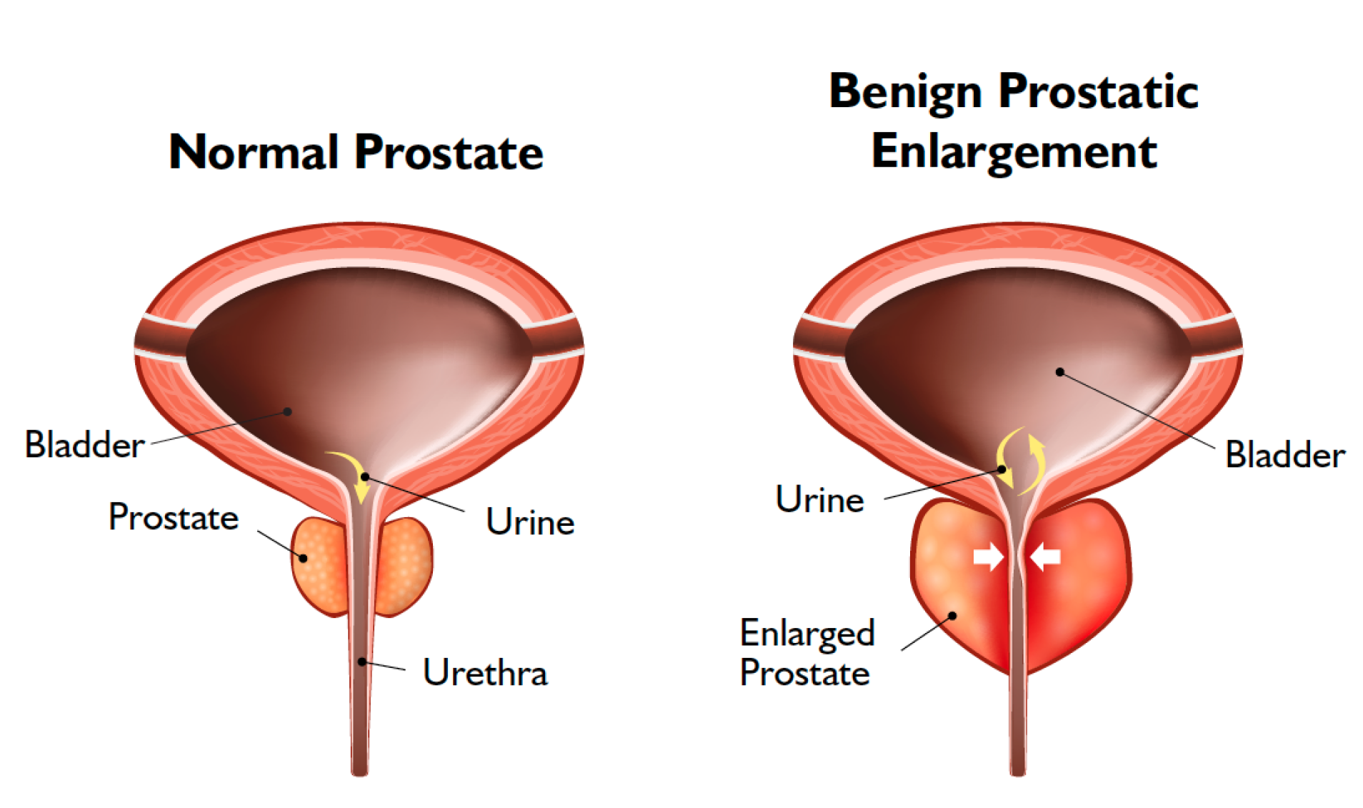 What Are The Symptoms Of Benign Prostatic Hyperplasia Bph Bph Solution Sg